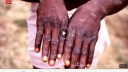 Der SRF-Titel «Afrikanische Infektionskrankheit greift auf Europa über» ist für die Ombudsstelle nicht rassistisch, er läuft aber den WHO-Empfehlungen zuwider. (Bild Screenshot SRF)